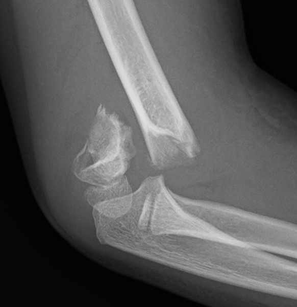 supracondylar-fracture-the-bone-school